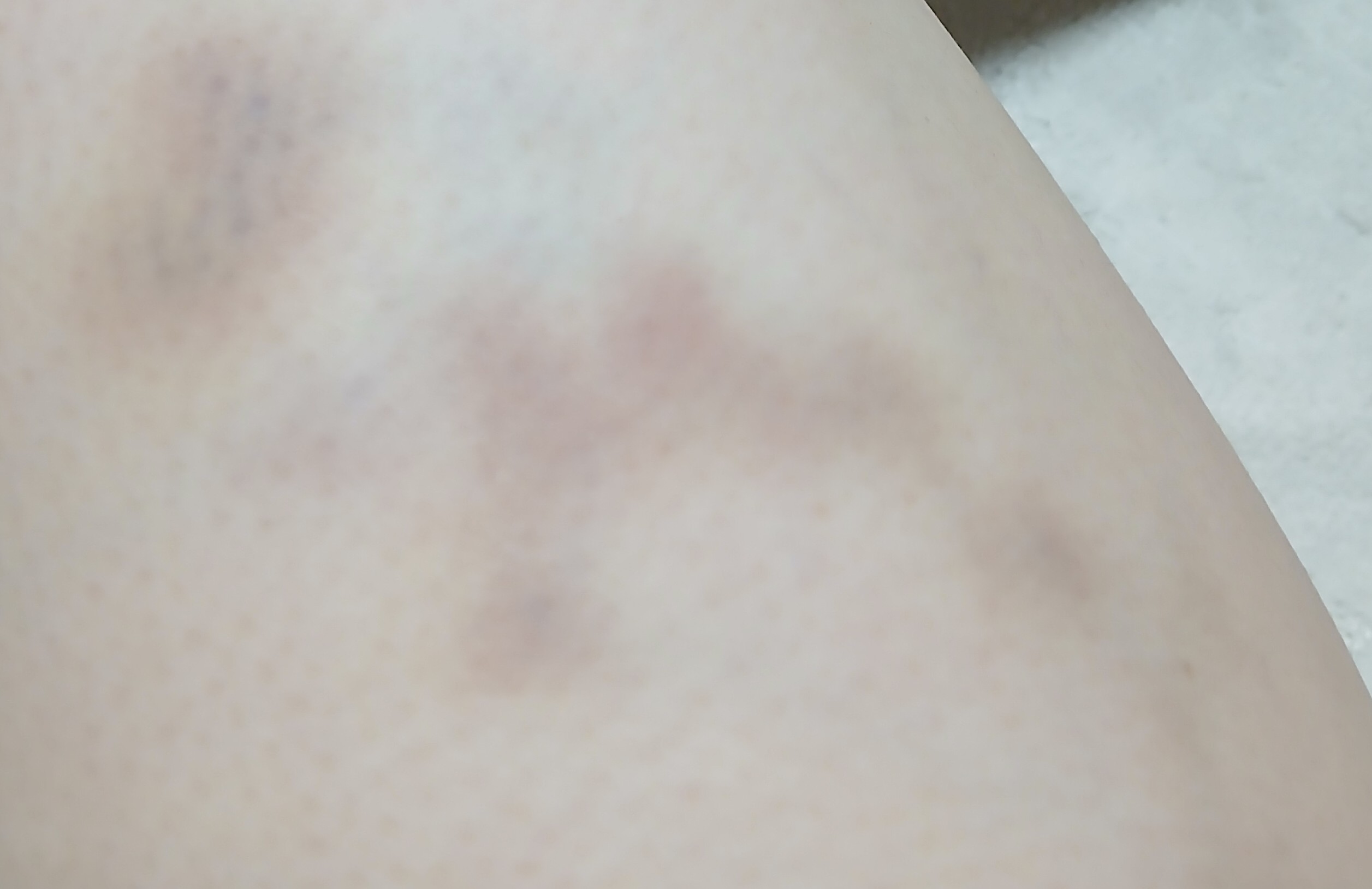 スレッドヘッダー画像: 仕事でできた足のアザ。一般雇用とはこういうものだ。