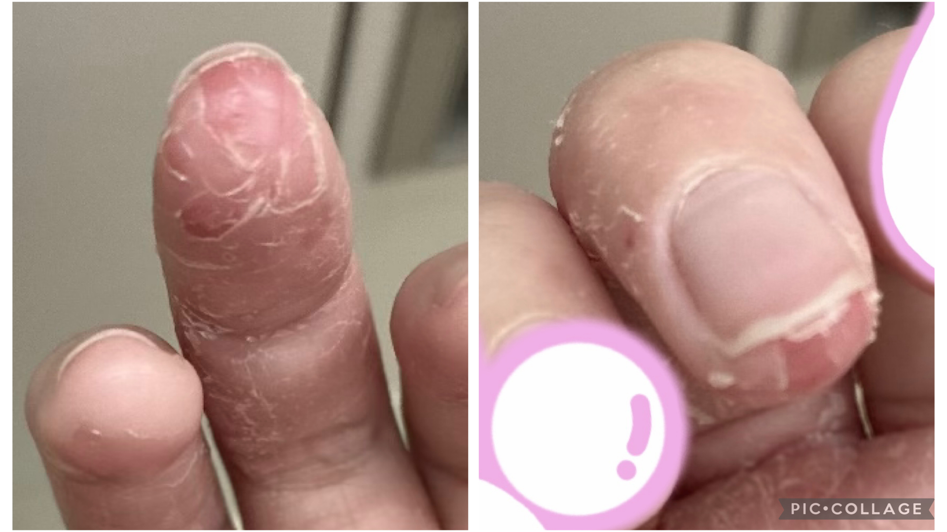 スレッドヘッダー画像: 手荒れやばい