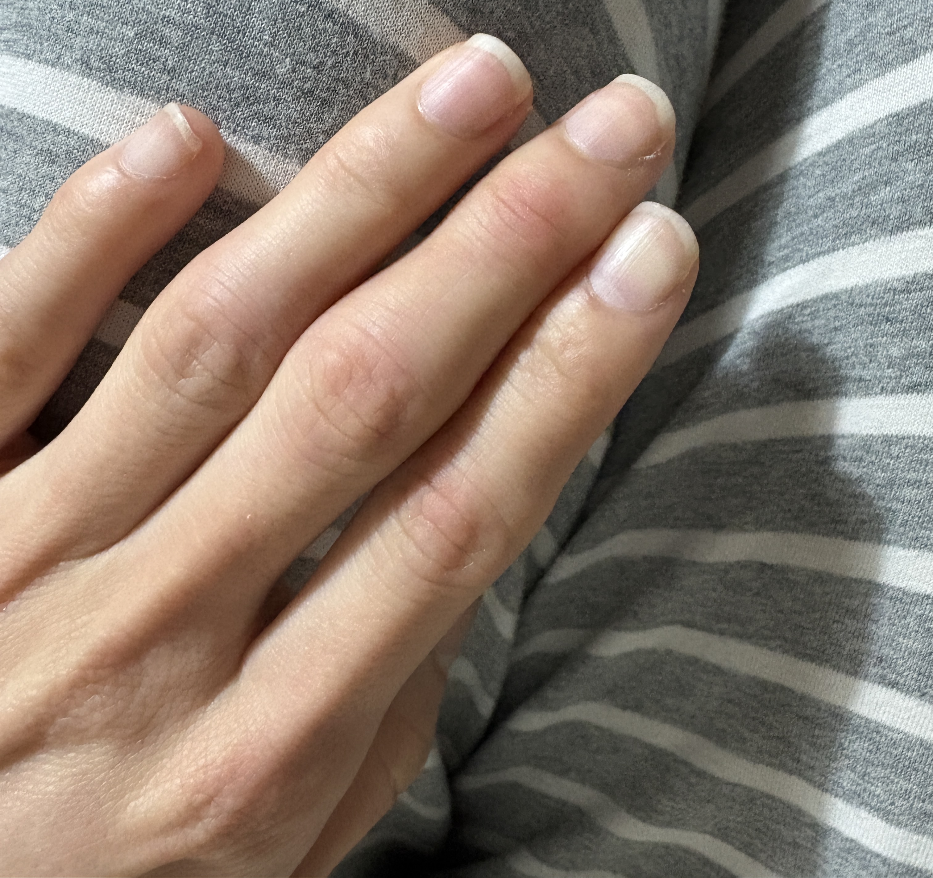 スレッドヘッダー画像: 謎症状なんだけどここ数日左手指が痛いの。押しても痛いし動かしても痛い。右手と比べると少し浮腫んでるようにも見える。なんだろうこれ